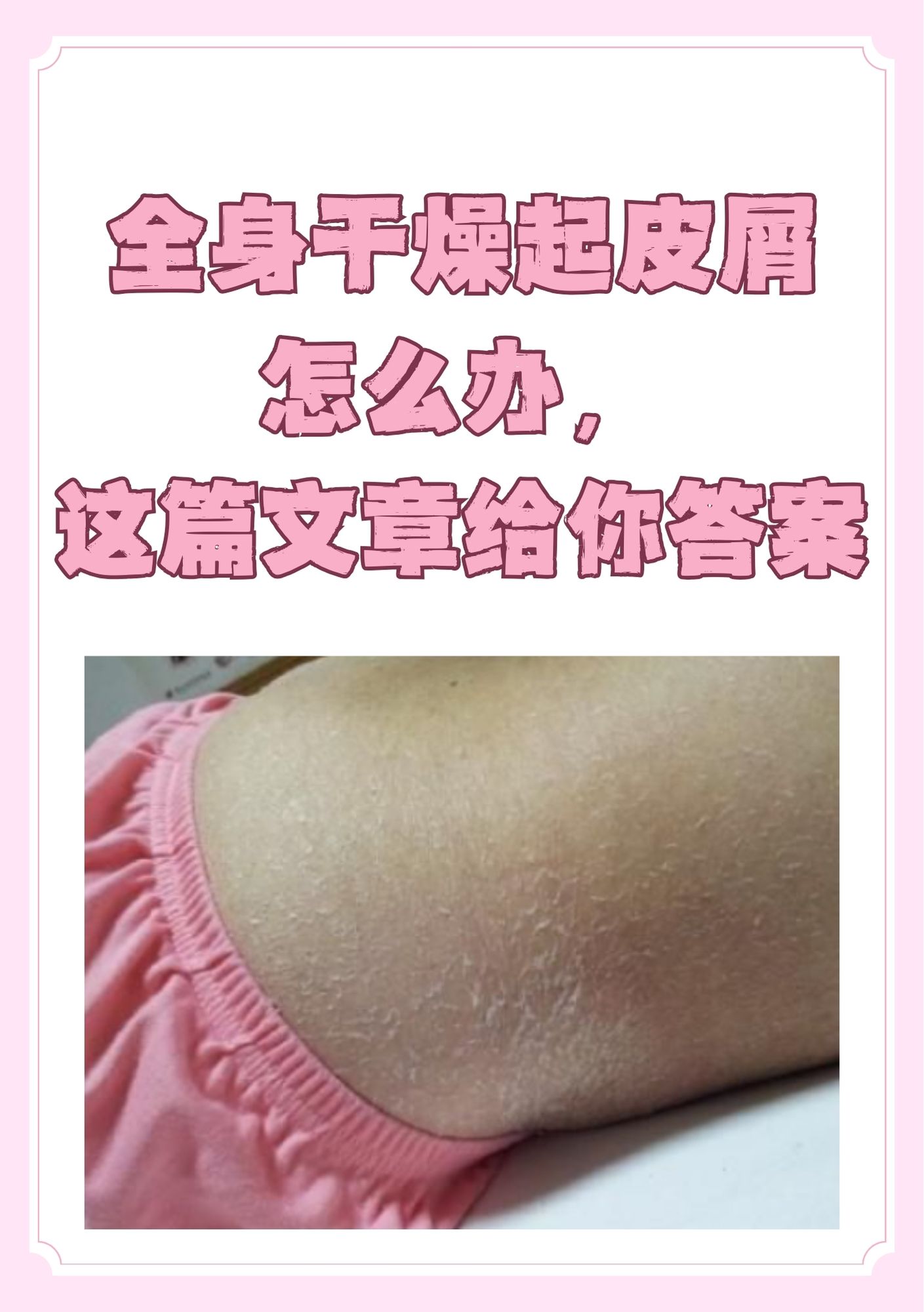 孩子皮肤干燥怎么办