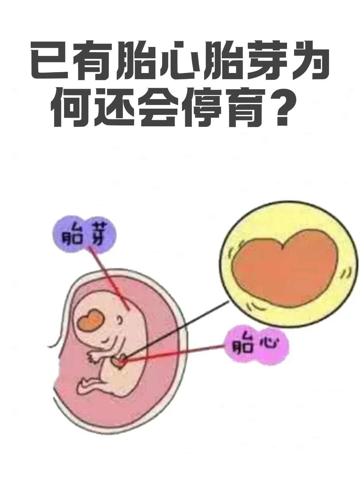 没有胎心的原因