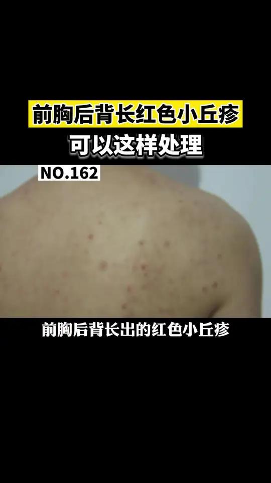 前胸后背长痘痘是什么原因引起的