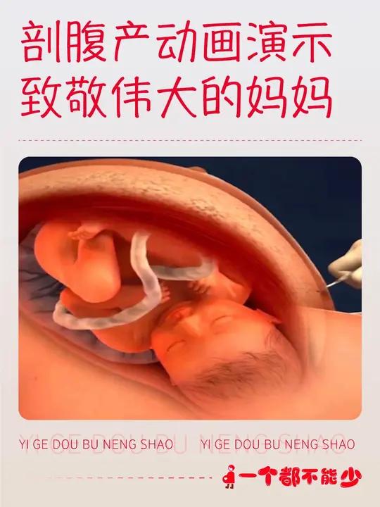 剖腹产是什么意思