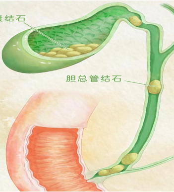 胆结石是怎么形成的