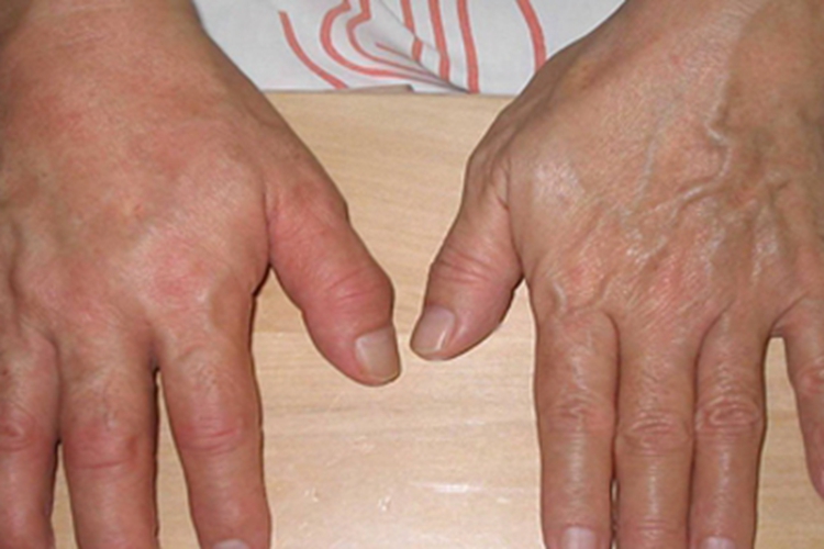 面肌肉萎缩的症状有几种