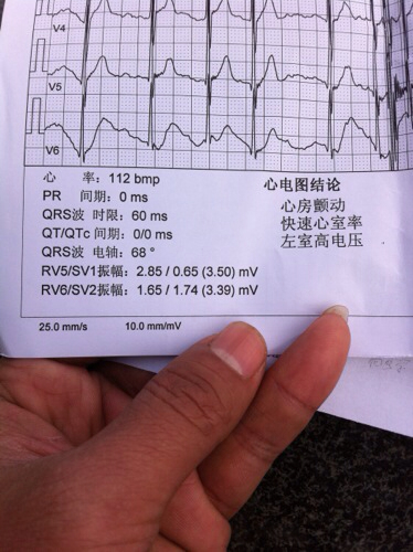 左心室高电压是怎么回事