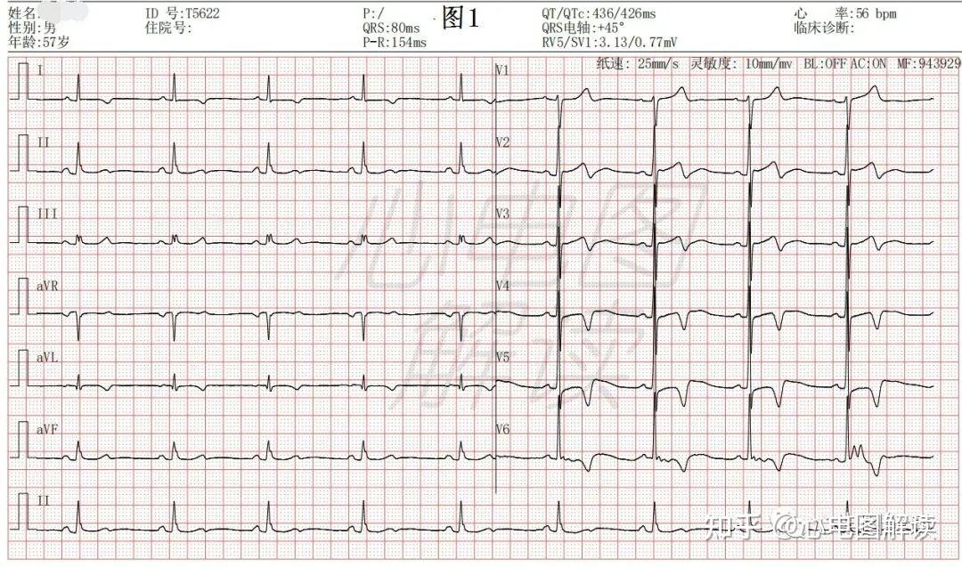 左心室高电压是怎么回事
