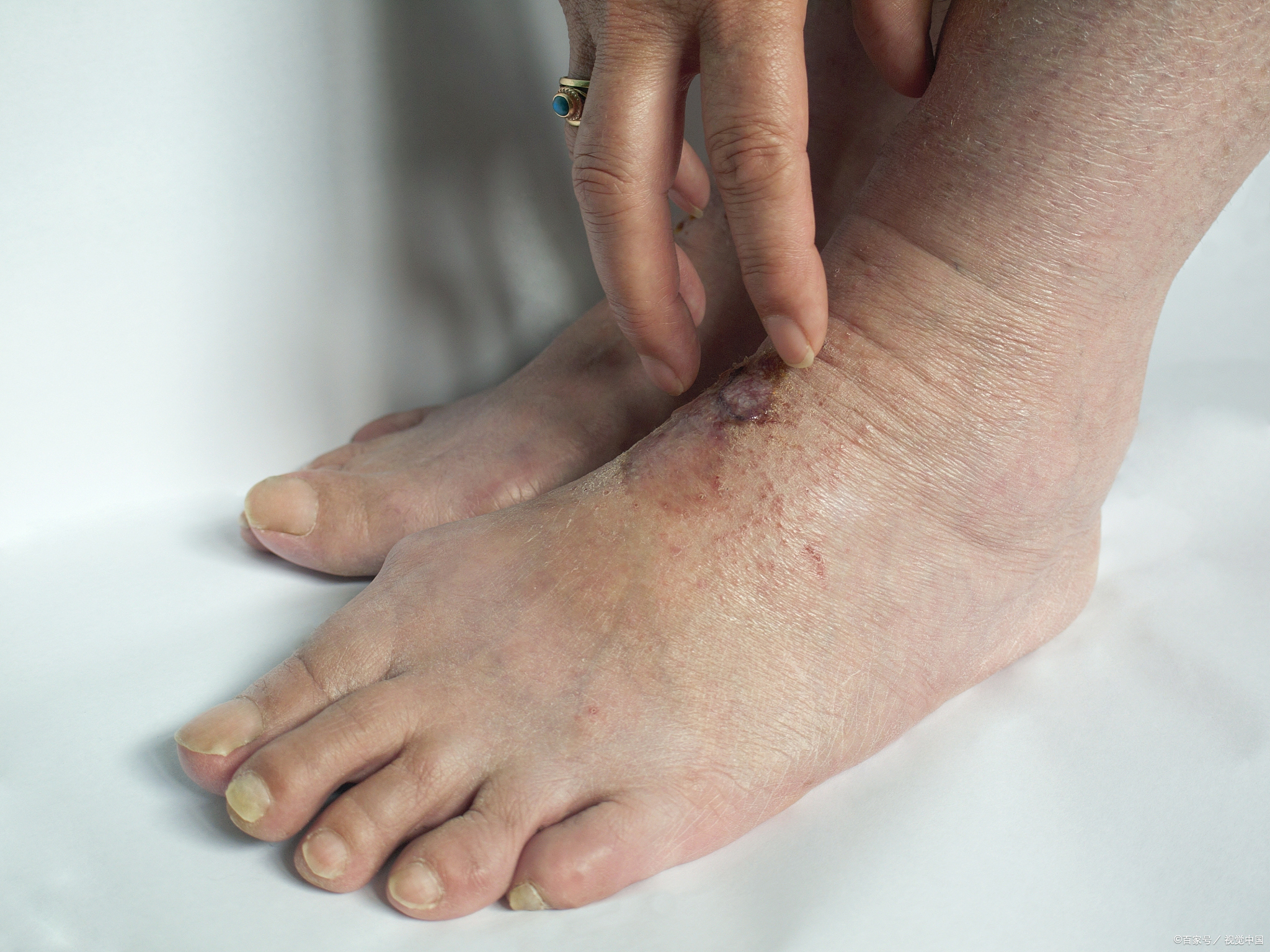 老人脚肿怎么办