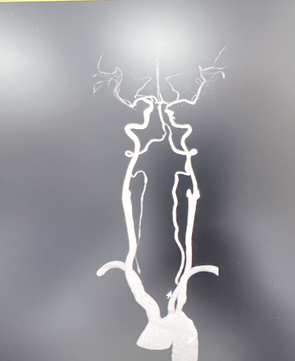 椎动脉狭窄的临床表现