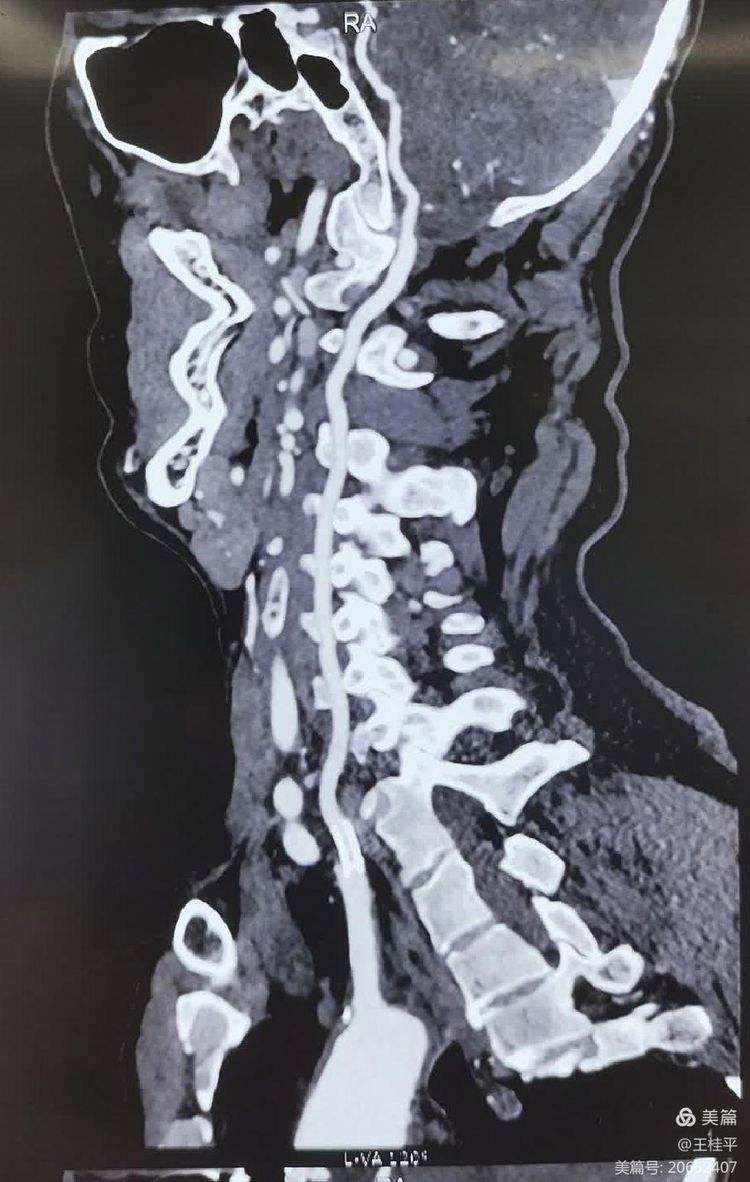 椎动脉狭窄的临床表现