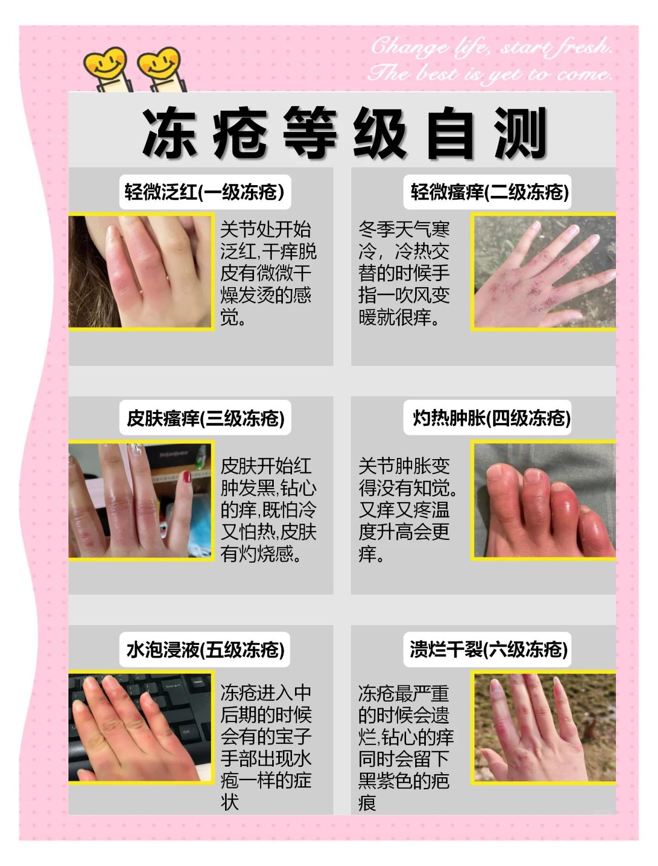 冻疮怎么治疗疗效快