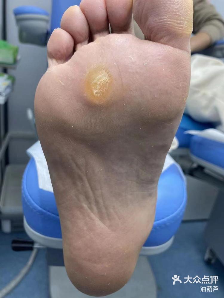 脚被钉子扎伤怎么处理