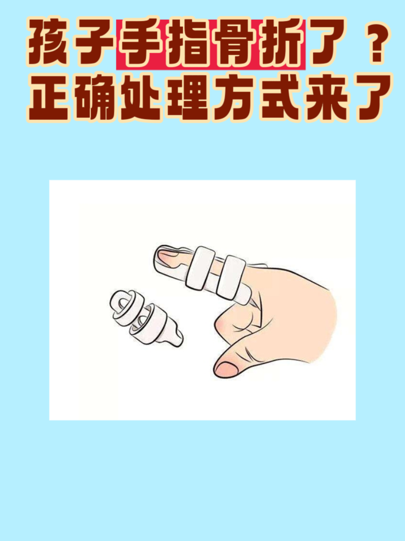 如何判断手指是否骨折