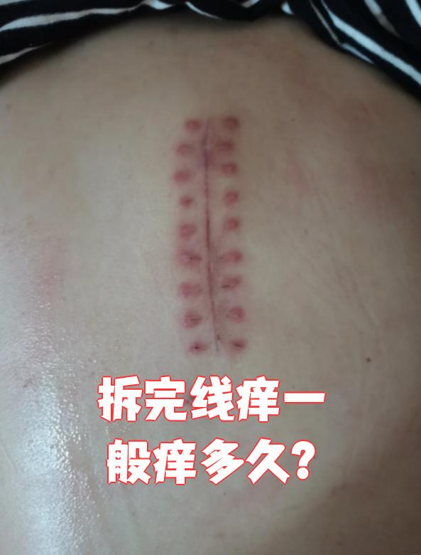 缝合的伤口几天拆线