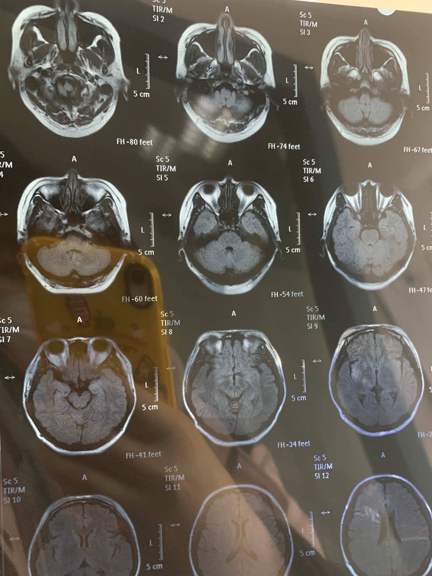 脑部核磁共振能检查什么