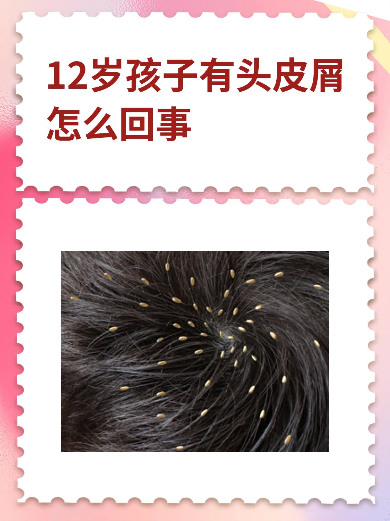 出现大块头皮屑的原因