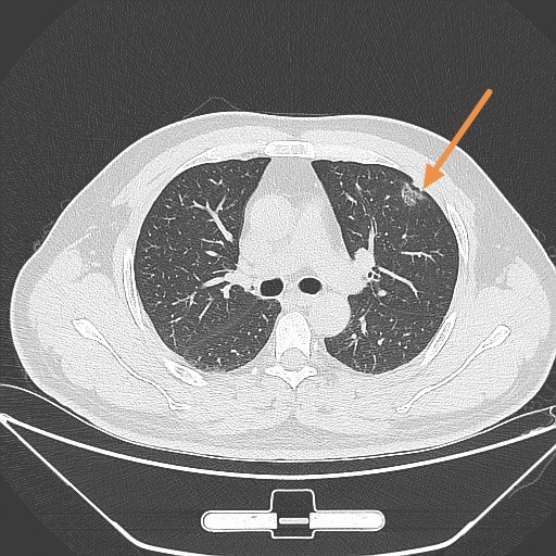 肺部磨玻璃结节6mm严重吗