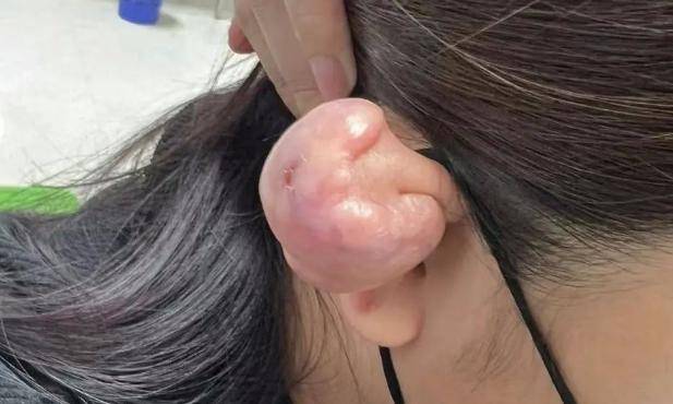 耳朵口上突然起来个疙瘩