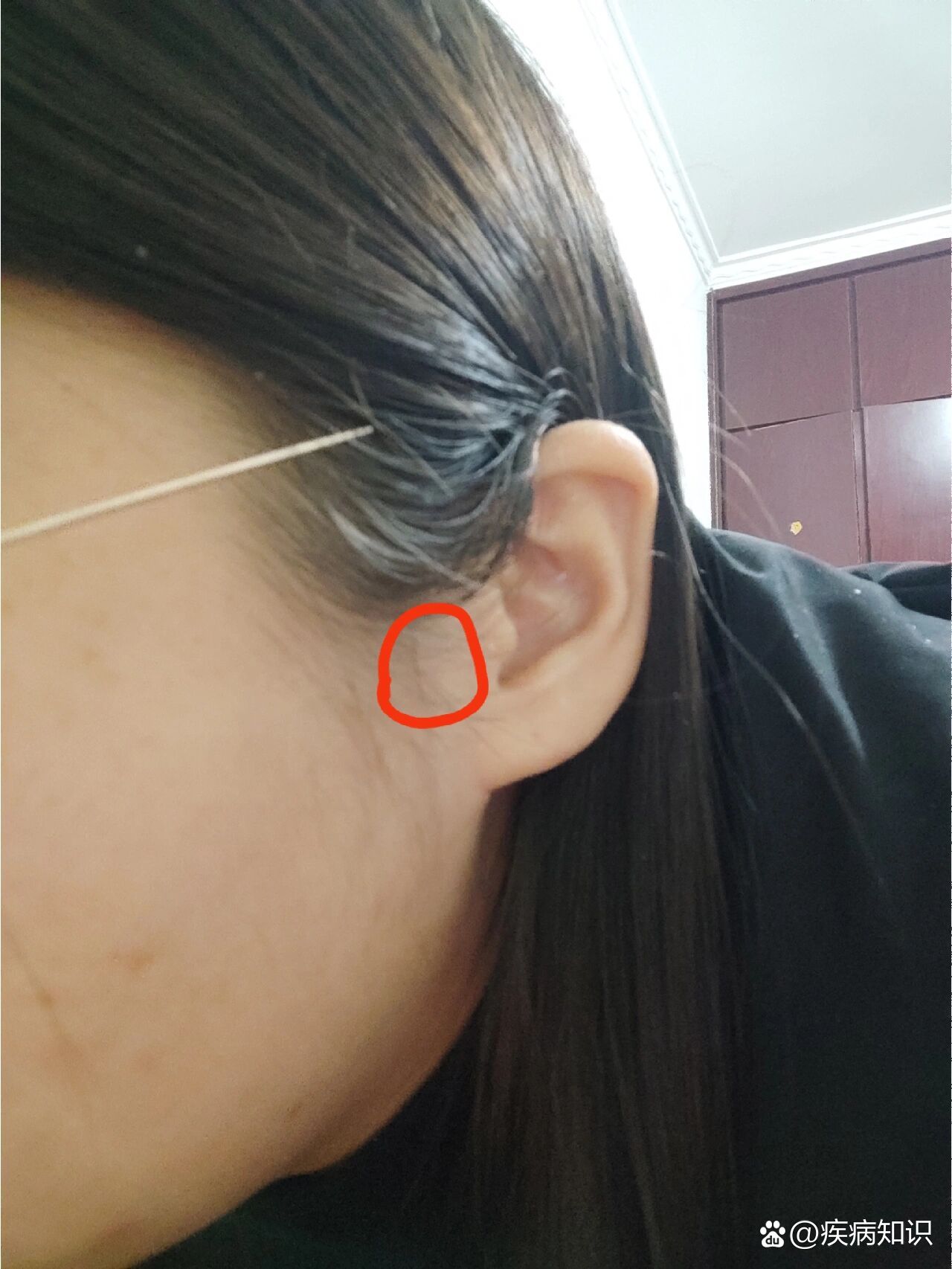 耳朵口上突然起来个疙瘩
