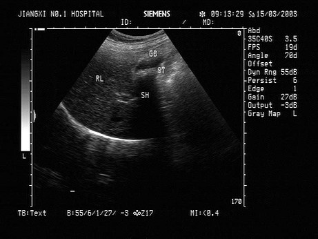 b超胆囊大小正常值是多少
