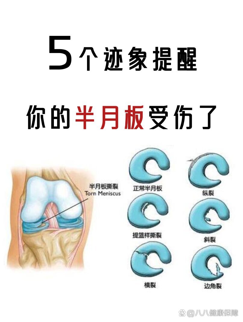 什么是半月板损伤?