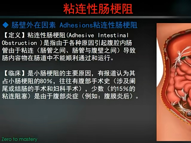 什么是粘连性肠梗阻?