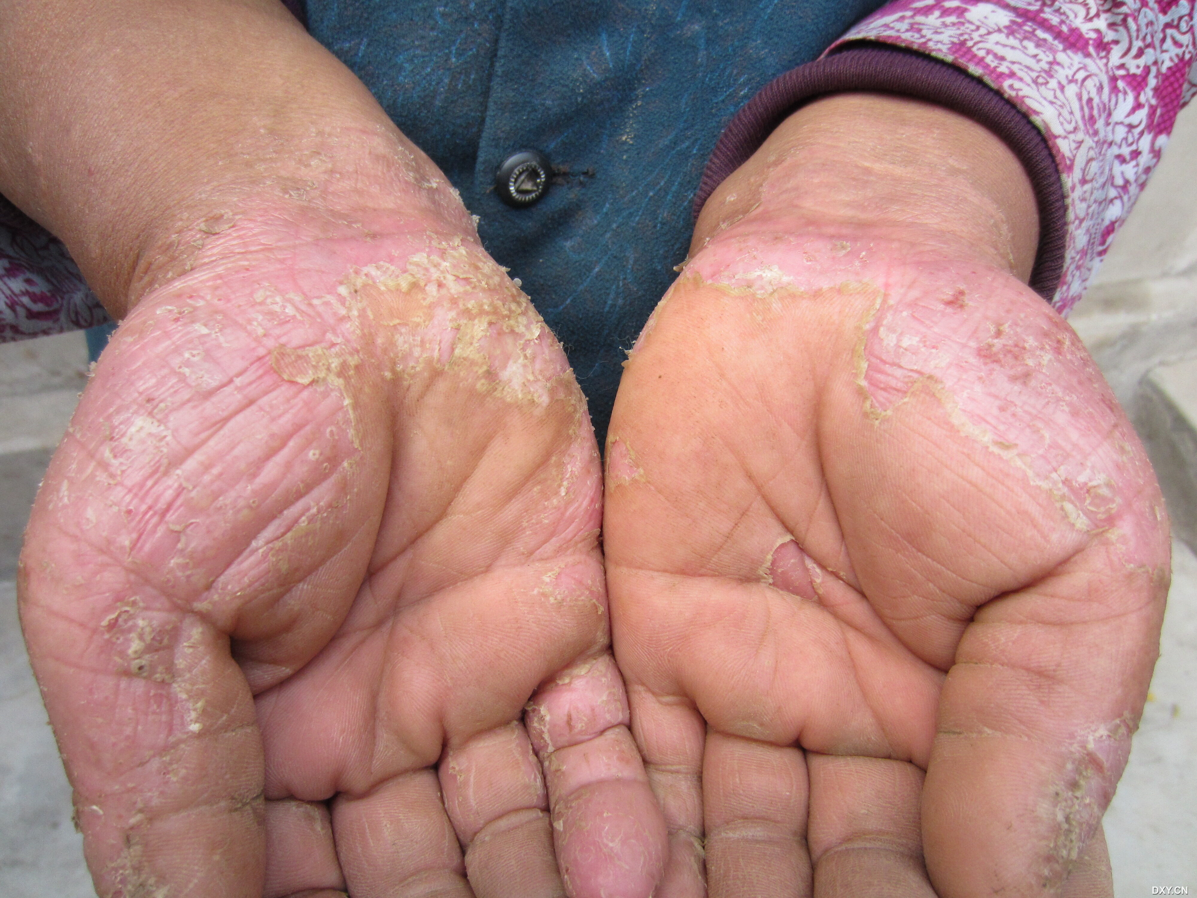 癞子是什么样的症状?