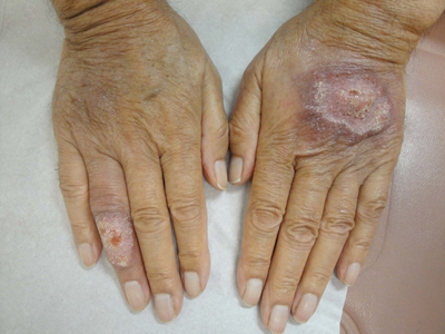 癞子是什么样的症状?