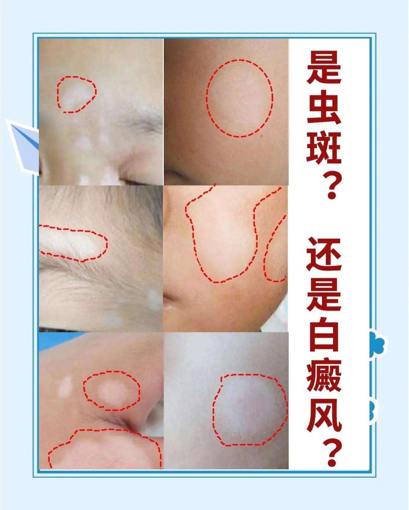 儿童脸上有白斑怎么回事?