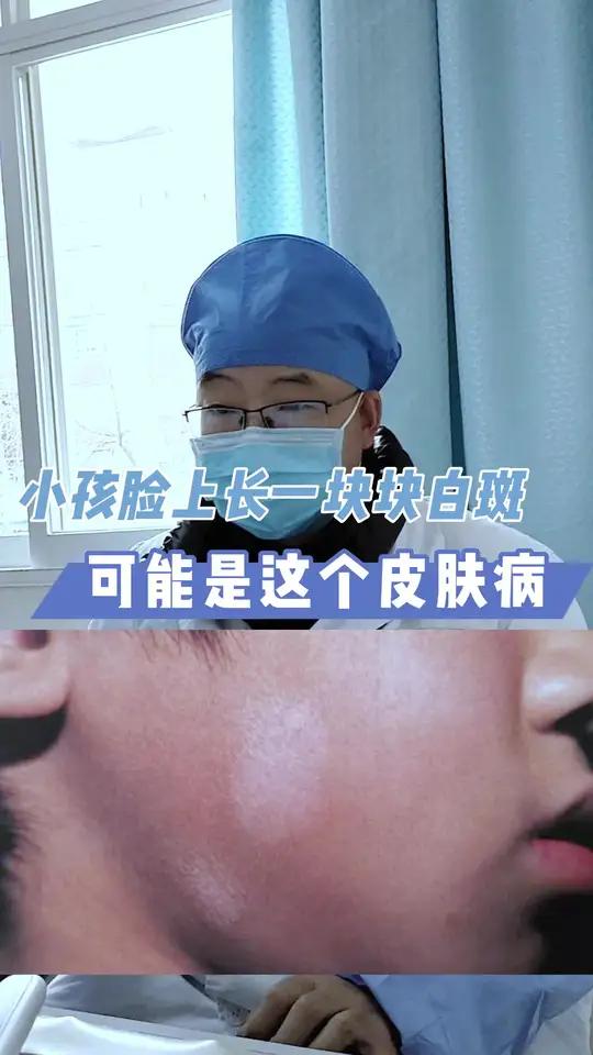 儿童脸上有白斑怎么回事?