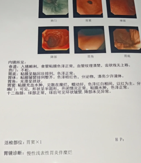 胃炎糜烂性胃炎严重吗