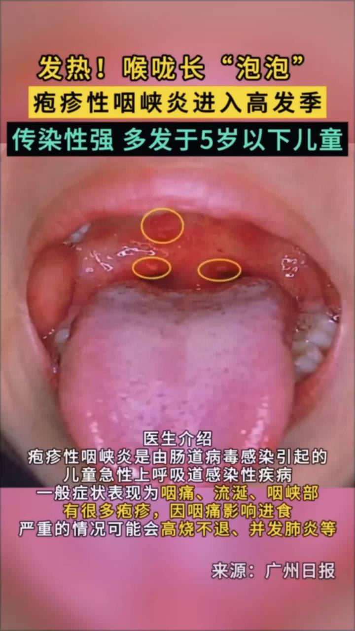 疱疹性咽峡炎会传染吗?