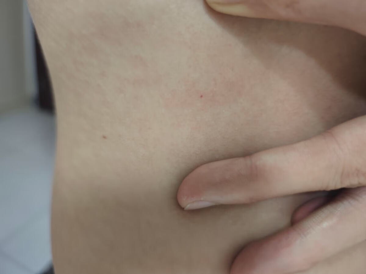 血管痣有什么危害吗