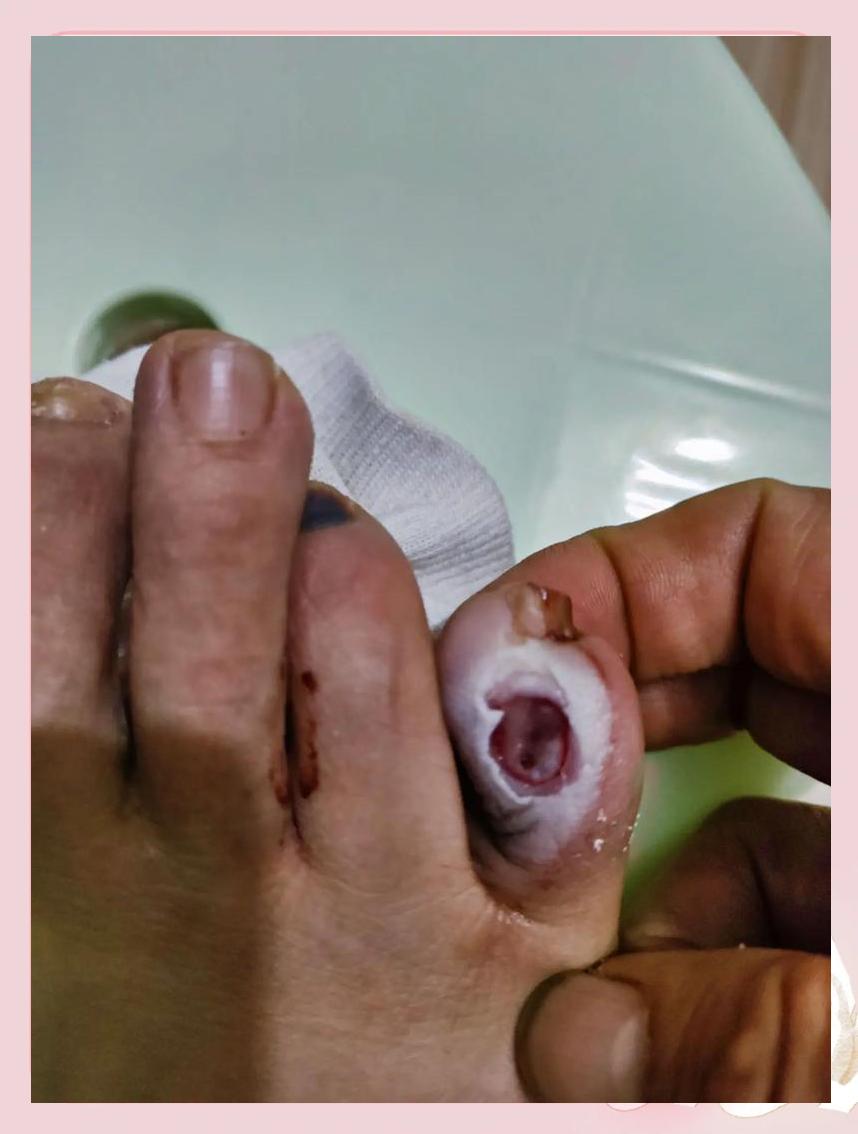 脚上长鸡眼怎么治疗?