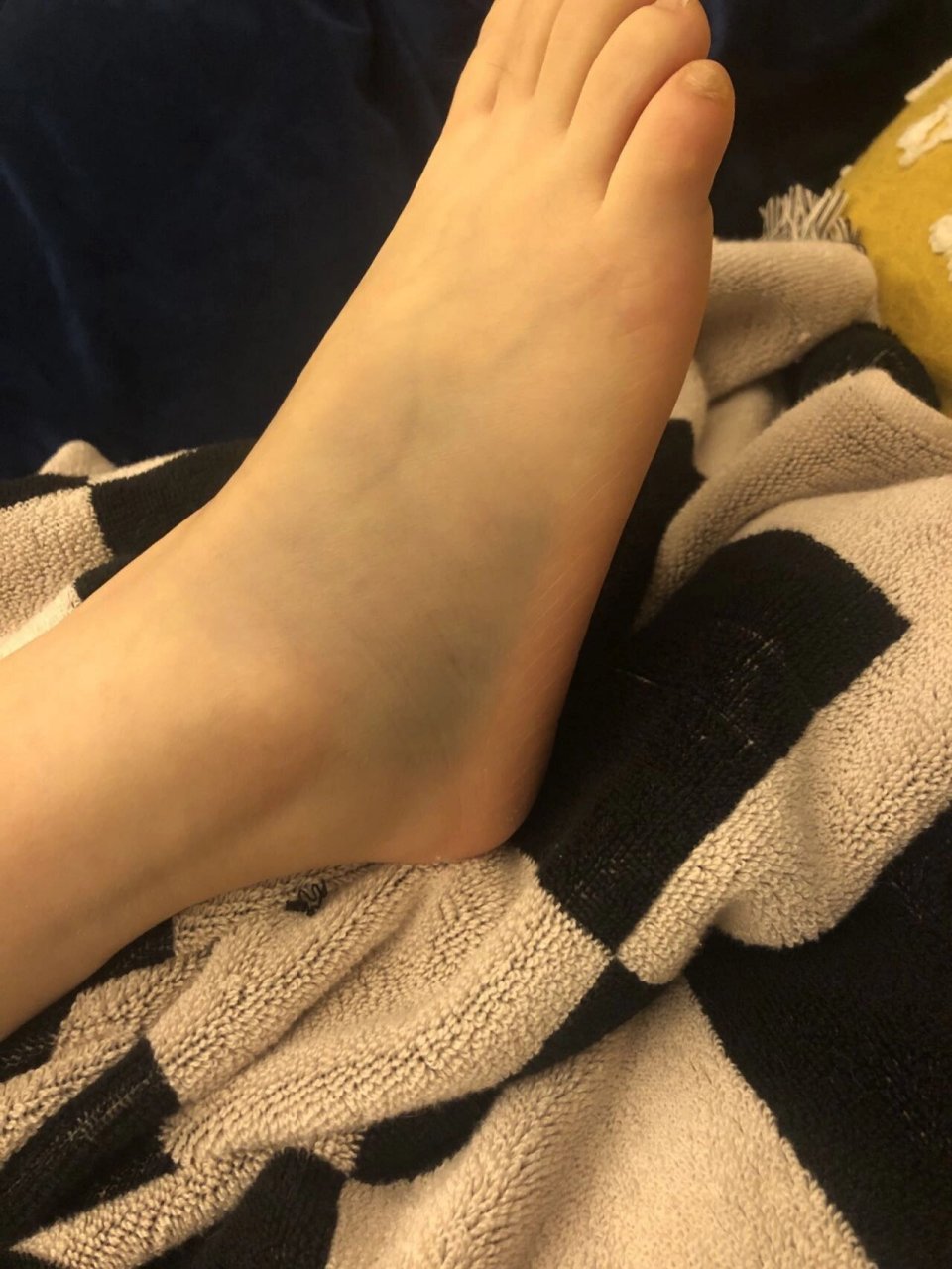 骨折的症状有哪些