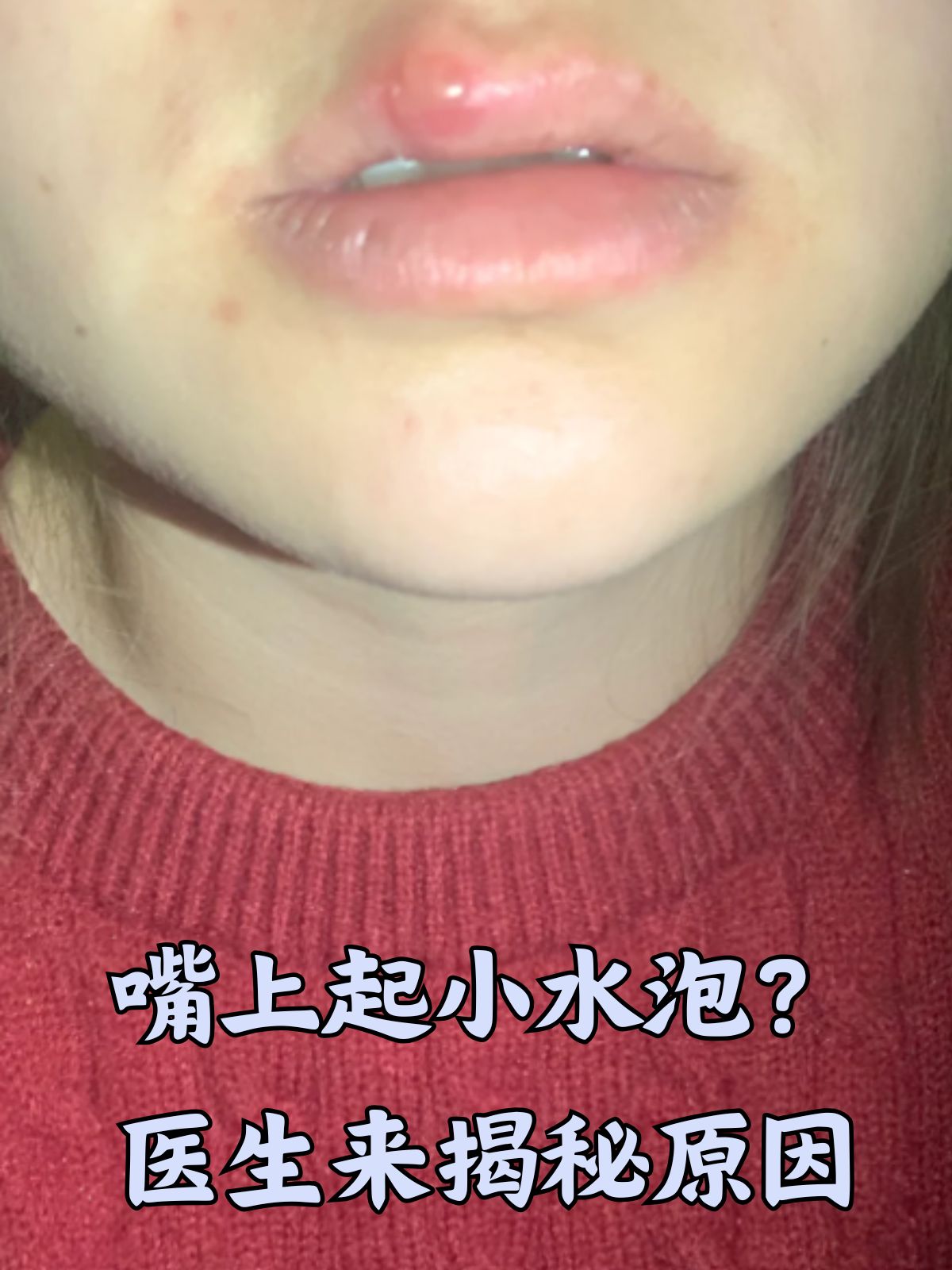 嘴唇起水泡,怎么办?