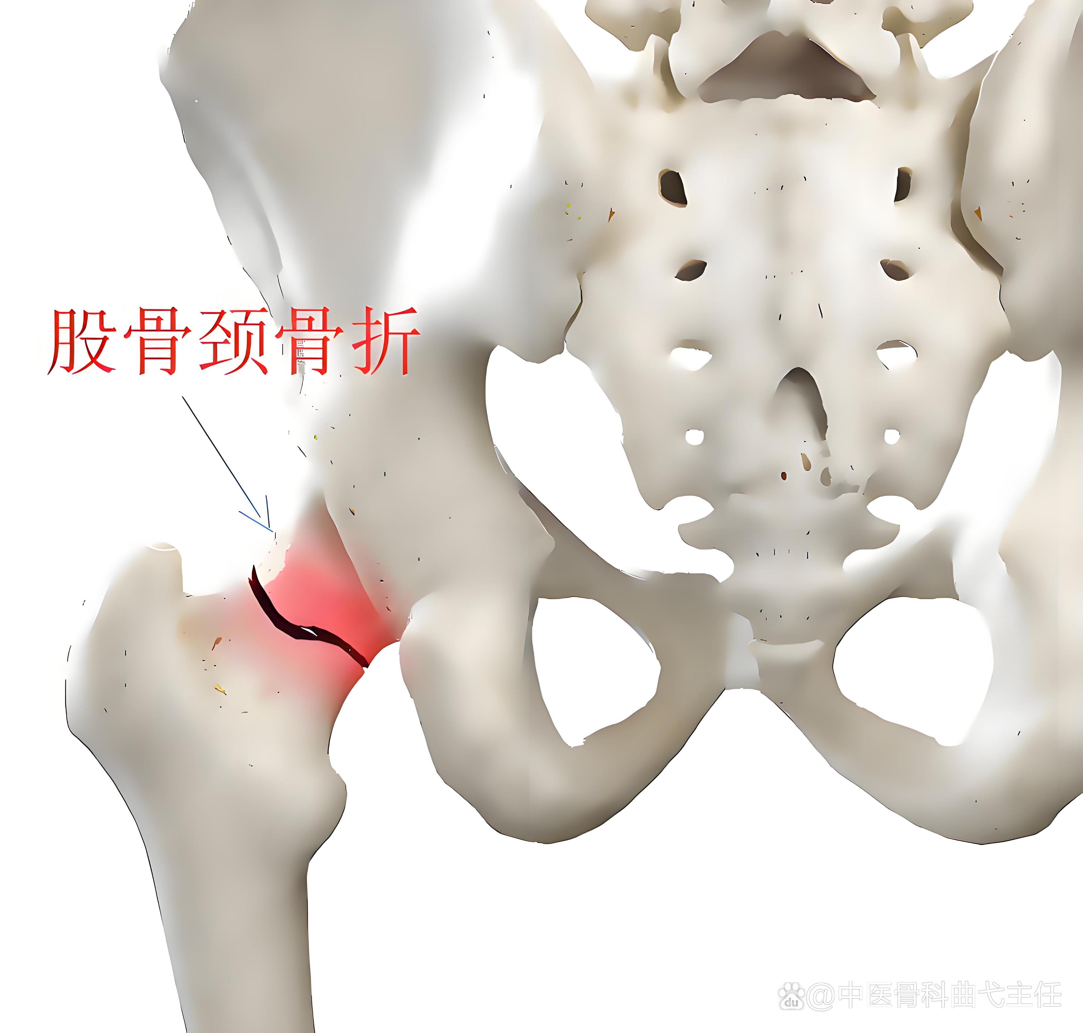 股骨颈骨折可以治愈吗?