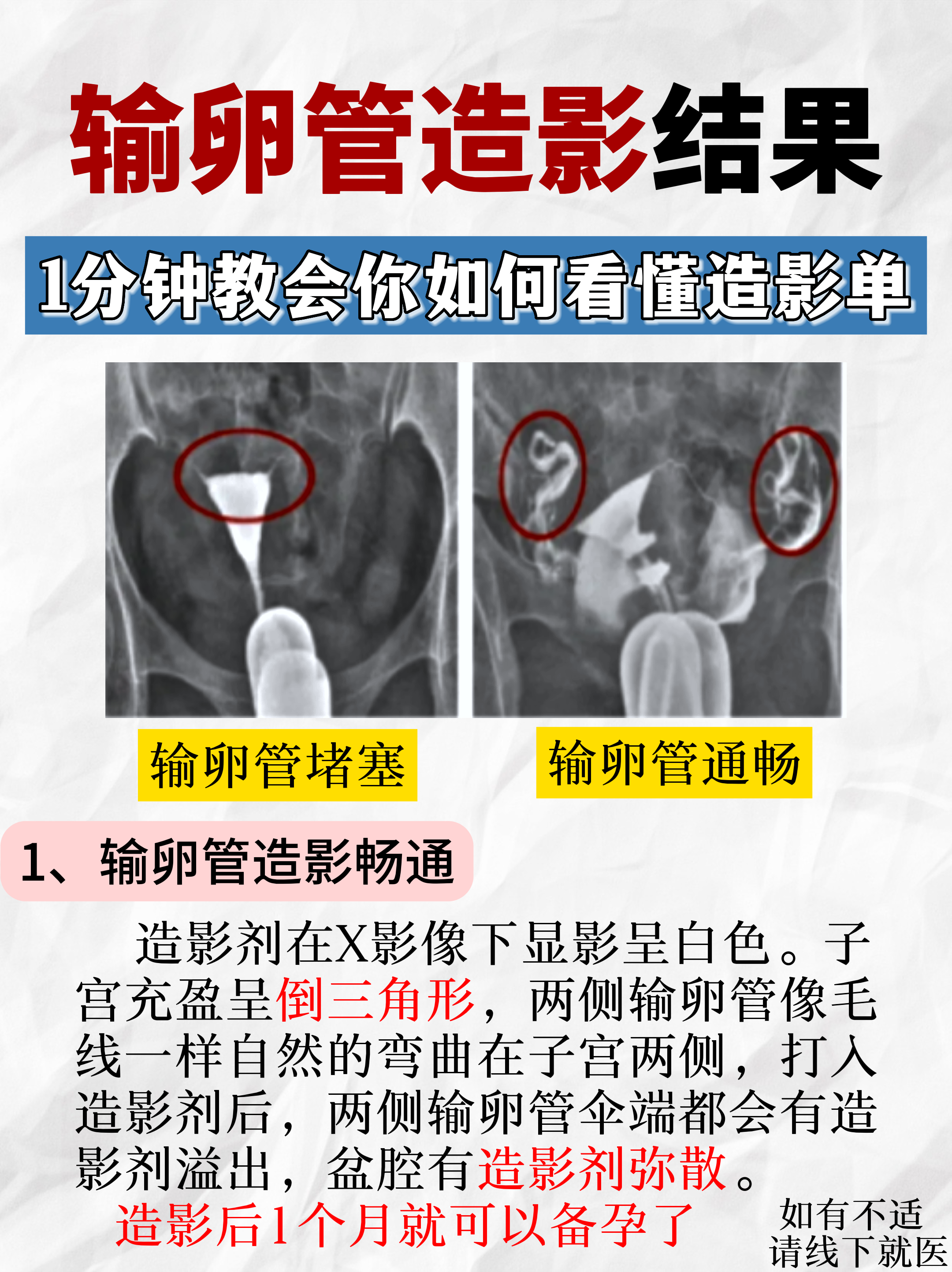输卵管造影检查的注意事项有哪些?