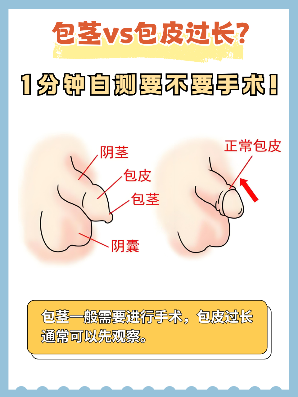 什么是包皮过长,能发个图片吗?