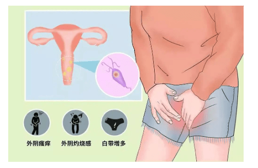 滴虫性阴道炎的最佳治疗方法