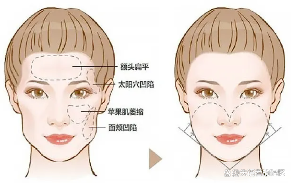 玻尿酸填充太阳穴有用吗