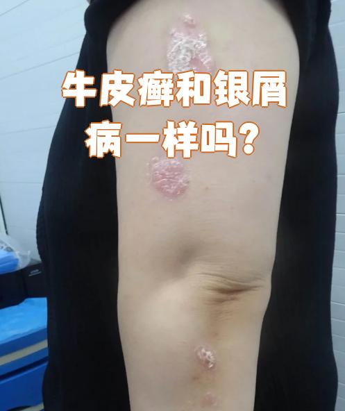 牛皮癣会遗传吗