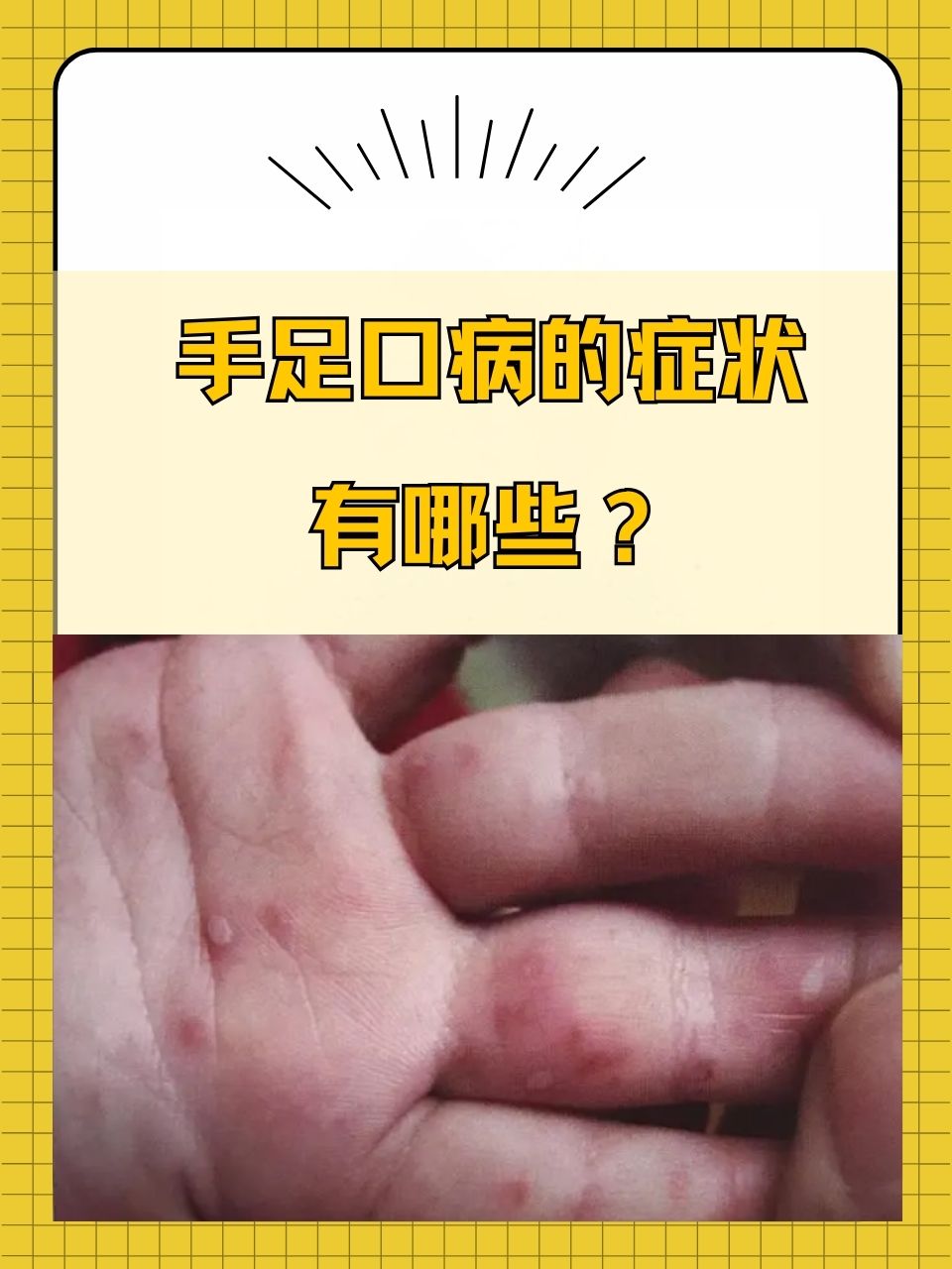 手足口病一定会发烧吗