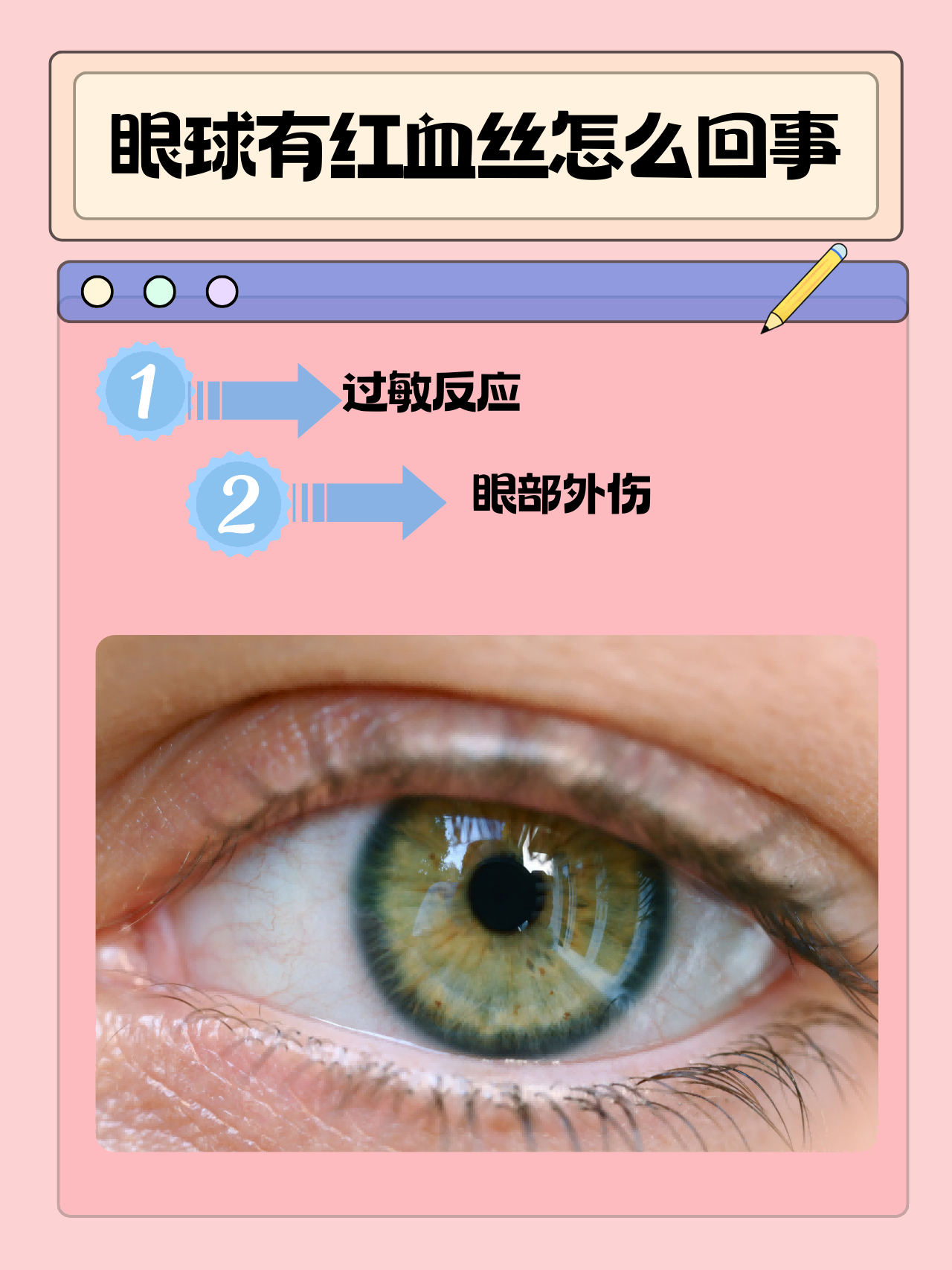 眼睛出现红血丝怎么回事