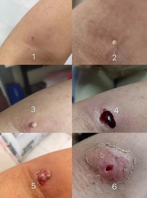 长了疖子怎么办