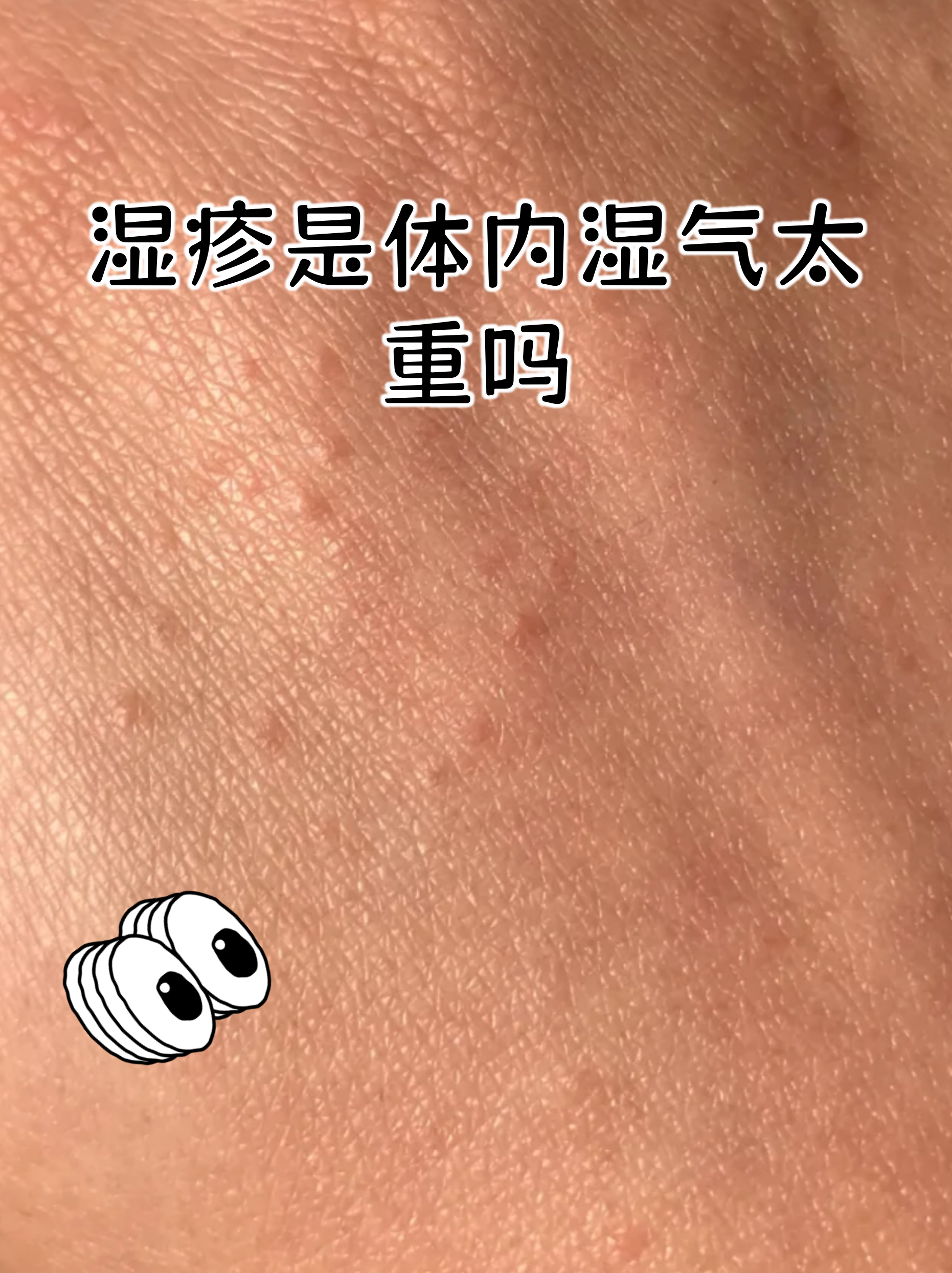 湿疹是不是体内湿气重