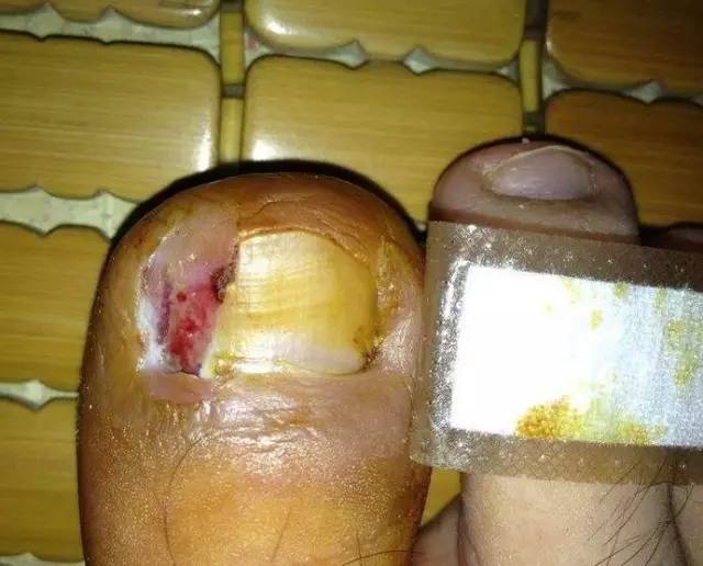 甲沟炎挂号挂什么科室