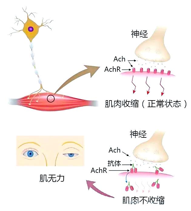 重症肌无力的病因