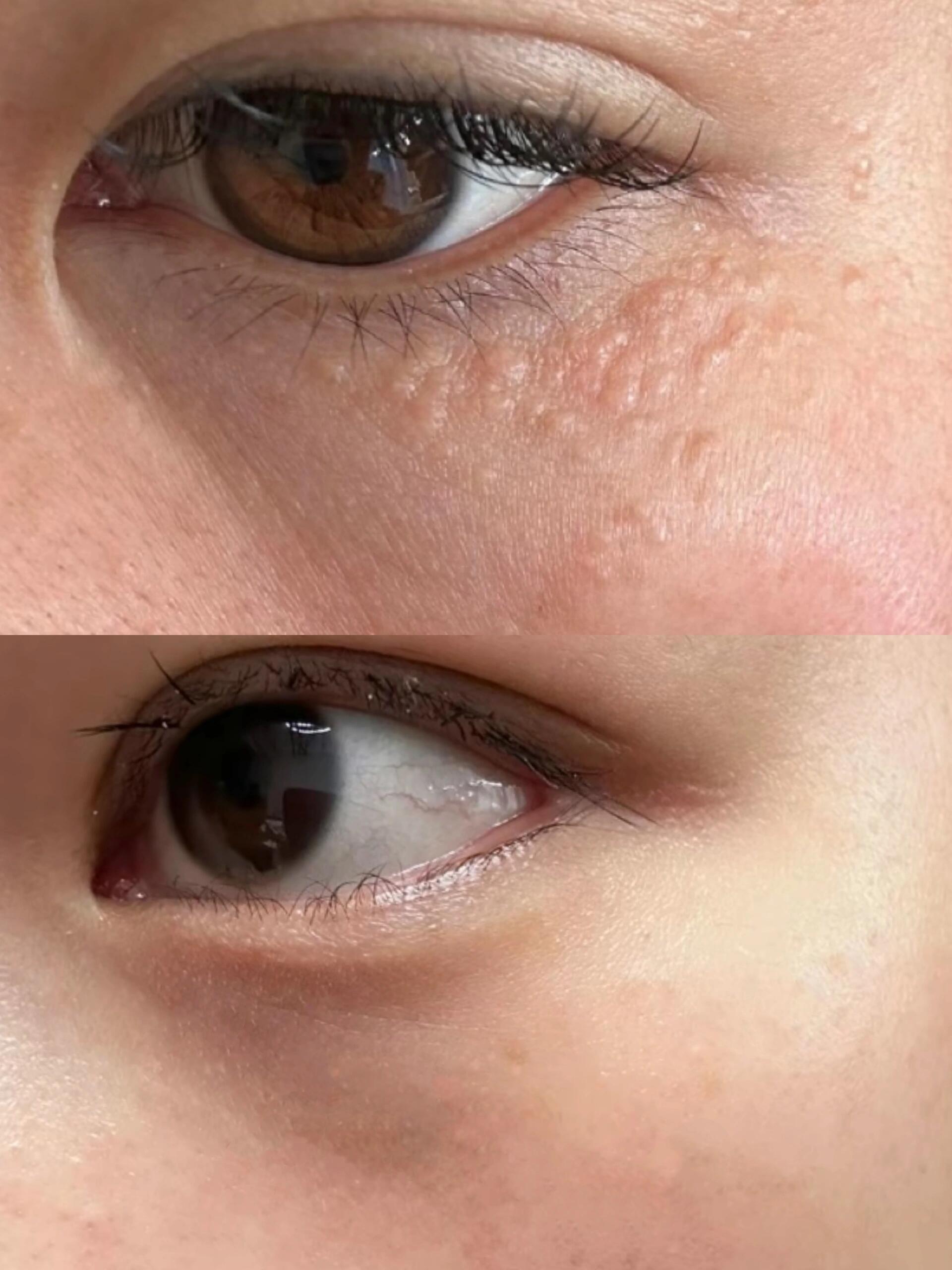 脸上脂肪粒怎么去除