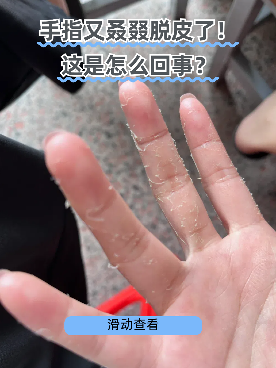 手指脱皮是什么原因引起的？