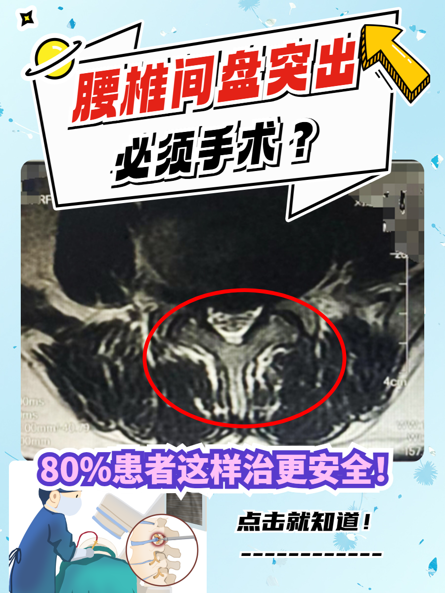 腰椎间盘突出一定要手术吗