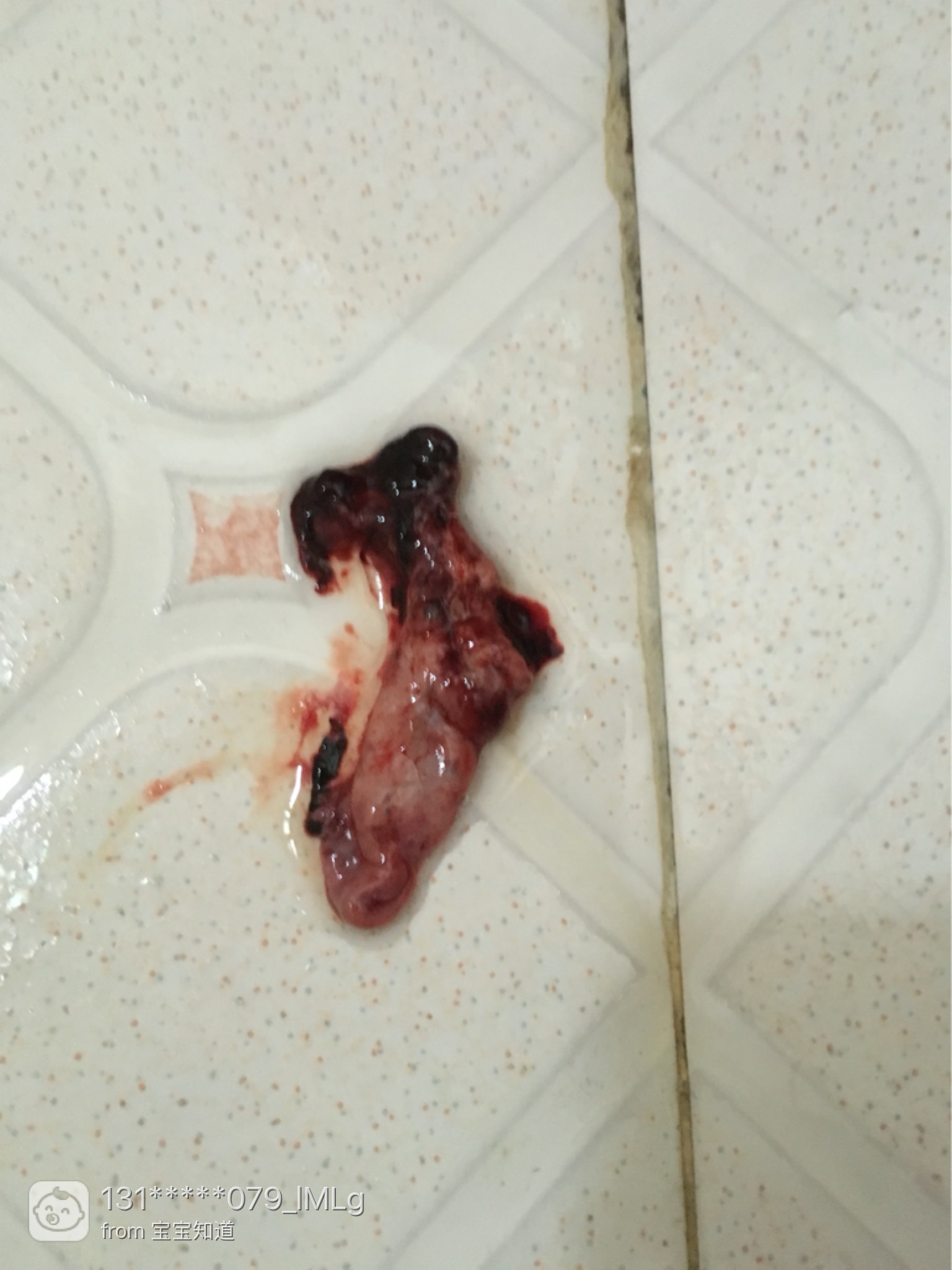 早期自然流产症状有哪些