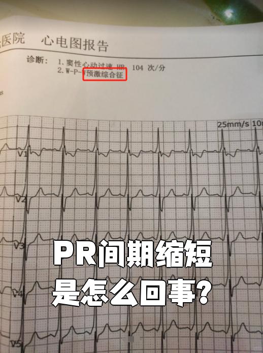 窦性心律pr间期正常范围
